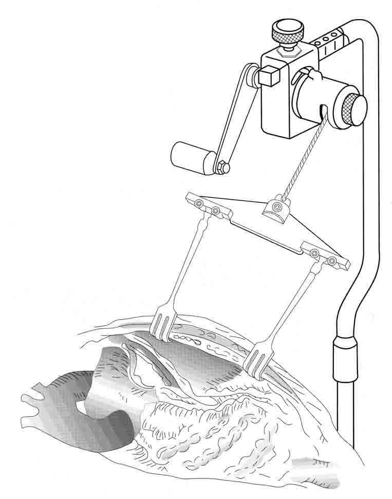 ÇIKRIK -Esnek Ekartör Seti Komple